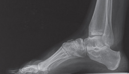 Maria de Lluc, experta en podología, habla acerca del Hallux Flexus
